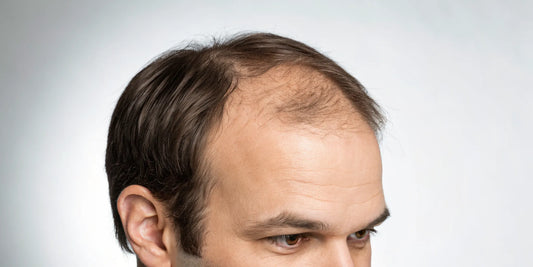 A close-up of a scalp with hair thinning before GHK-Cu peptide injections for hair growth.
